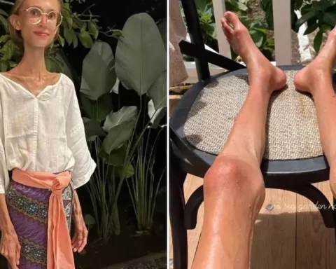 Meyve Diyetiyle Zayıflayan Sosyal Medya Fenomeninin Ölümü Aşırı Yetersiz Beslenmeye Bağlandı