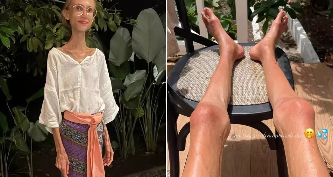 Meyve Diyetiyle Zayıflayan Sosyal Medya Fenomeninin Ölümü Aşırı Yetersiz Beslenmeye Bağlandı