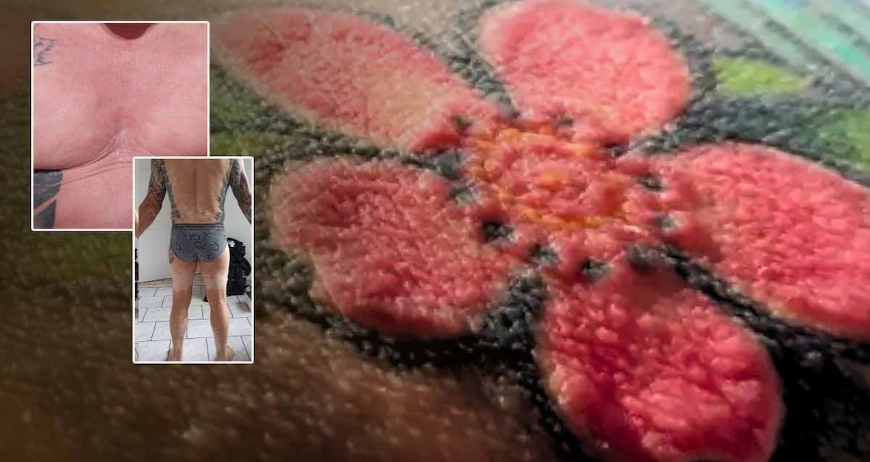 Kırmızı dövme sonrası tehlikeli reaksiyonlar ve kalıcı hasar riski