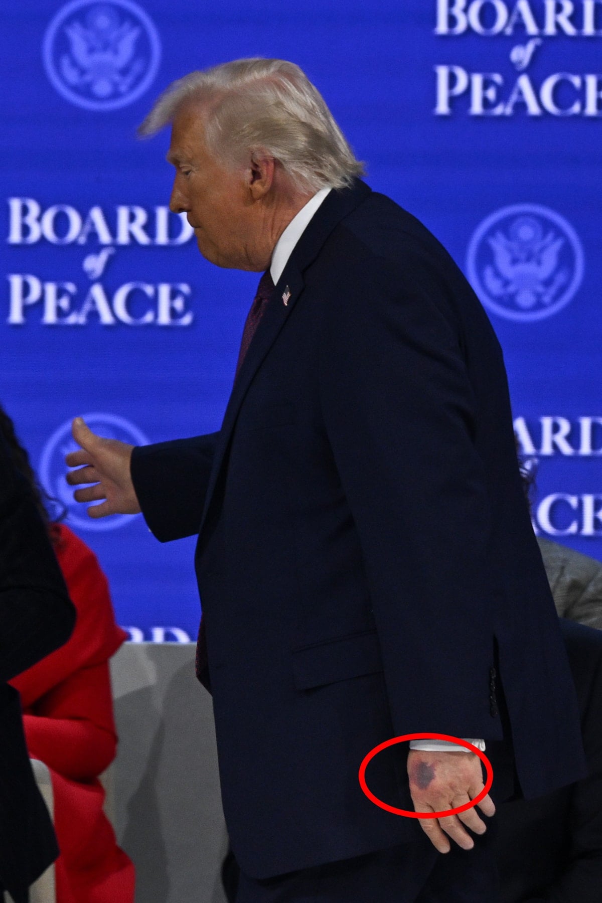 Trump'ın Moraran Eli, Uçakta Yaşadığı Kaza Sonucu Oldu