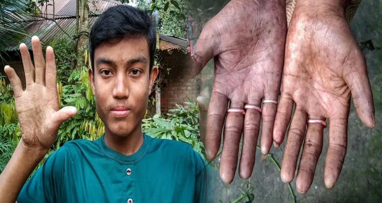 Nadir genetik durum nedeniyle biyometrik sistemlerin dışında kalan Bangladeşli aile sorunlar yaşıyor