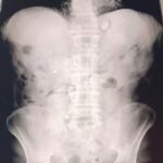 Uşak'ta İki İran Uyruklu Şüphelinin Midesinden 1 Kilo 70 Gram Metamfetamin Çıktı