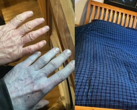 Maviye dönen cilt, tekstil boyasının sırrını ortaya çıkardı