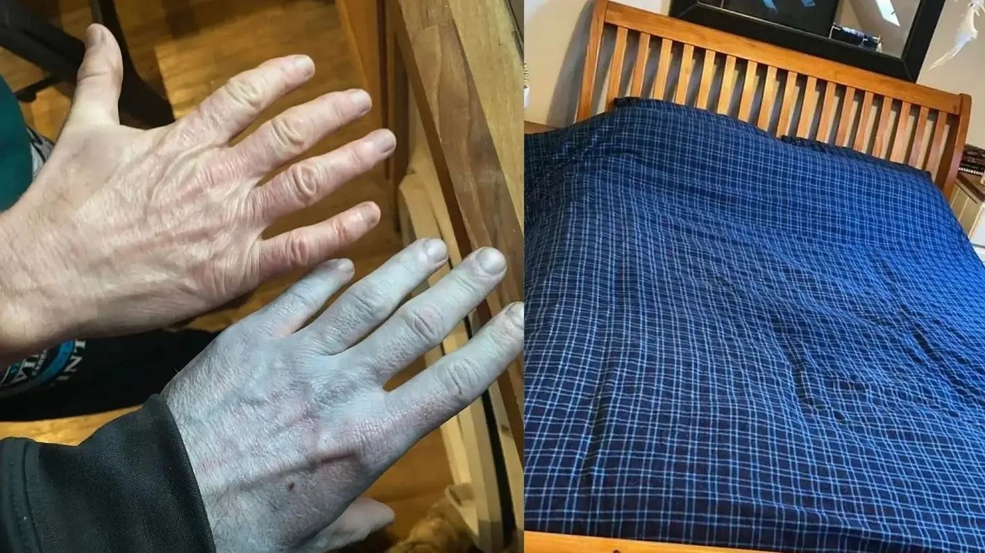 Maviye dönen cilt, tekstil boyasının sırrını ortaya çıkardı