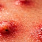 Uganda Tatilinden Dönen Kadında Görülen Sinek Larvası Enfeksiyonu Olayı