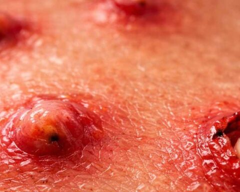 Uganda Tatilinden Dönen Kadında Görülen Sinek Larvası Enfeksiyonu Olayı